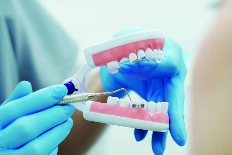 terapie ortodontica - aparat dentar