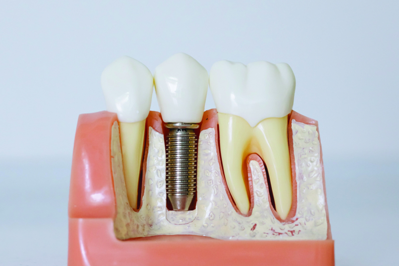 chirurgie orala - implant dentar